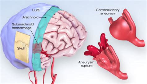 brain aneurysm and stroke